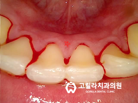 [치과공포증] 통증 적은 인레이, 크라운, 임플란트,사랑니발치 이미지 9