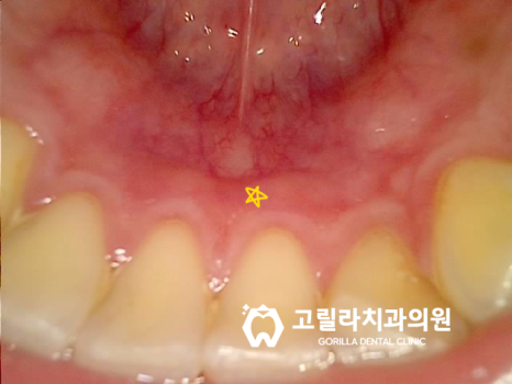 [치과공포증] 통증 적은 인레이, 크라운, 임플란트,사랑니발치 이미지 8