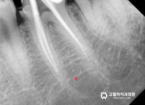 [신경치료] 치과마다 다른 복잡하고 어려운 치료 이미지 14