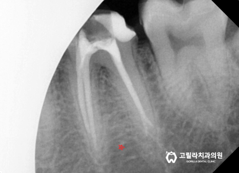 [신경치료] 치과마다 다른 복잡하고 어려운 치료 이미지 15