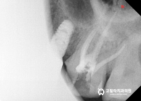 [신경치료] 치과마다 다른 복잡하고 어려운 치료 이미지 13