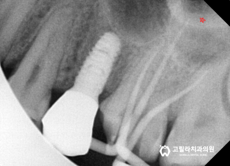 [신경치료] 치과마다 다른 복잡하고 어려운 치료 이미지 12