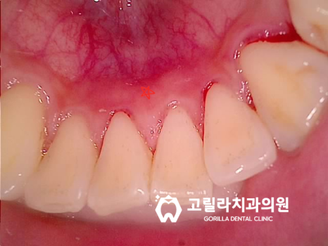 [앞니심미보철] 부러진 앞니 치아복원 이미지 9