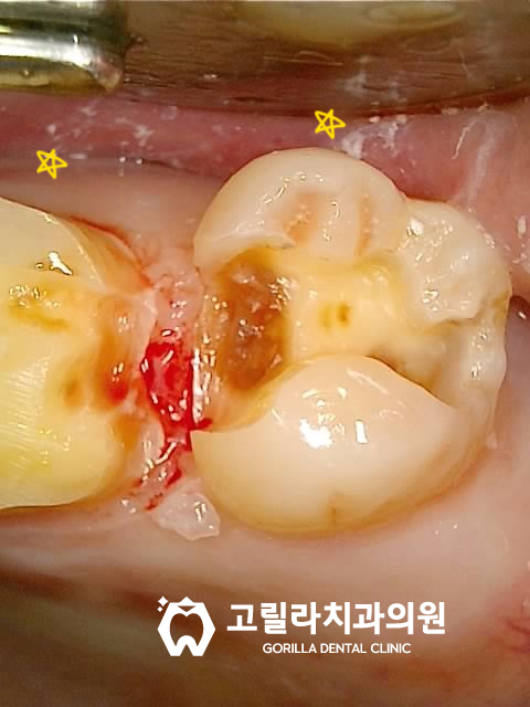 [앞니심미보철] 부러진 앞니 치아복원 이미지 14