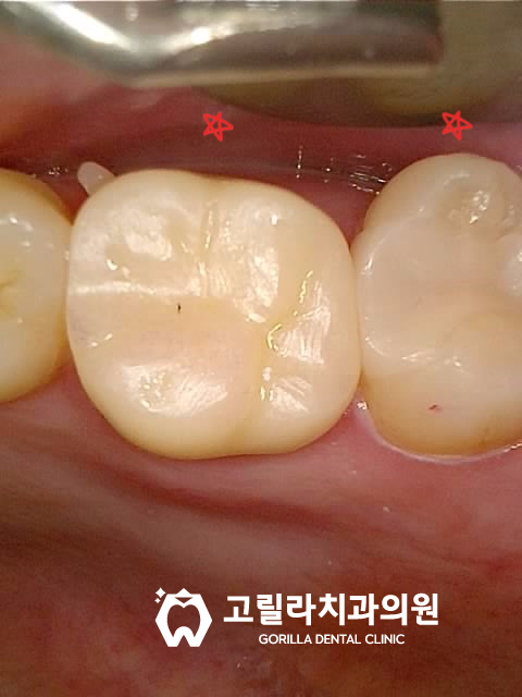[앞니심미보철] 부러진 앞니 치아복원 이미지 15
