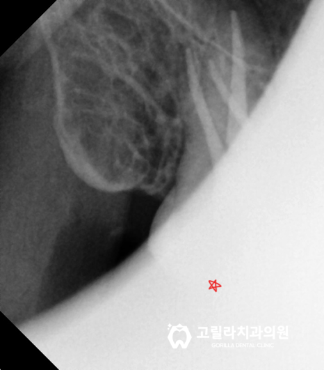 [충치치료] 다수의 레진,인레이,크라운 이미지 11