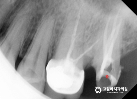 [교모가 심한 치아의 복원] 신경치료 & 크라운 이미지 15