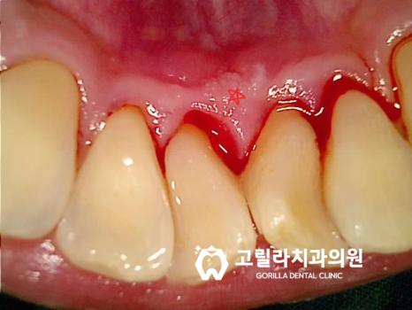 [교모가 심한 치아의 복원] 신경치료 & 크라운 이미지 11