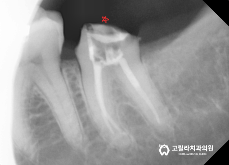 [교모가 심한 치아의 복원] 신경치료 & 크라운 이미지 16