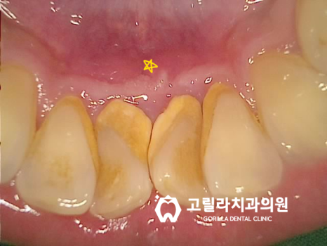 [교모가 심한 치아의 복원] 신경치료 & 크라운 이미지 10