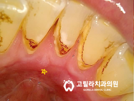 상악동 거상술을 동반한 즉시 임플란트 수술 이미지 8