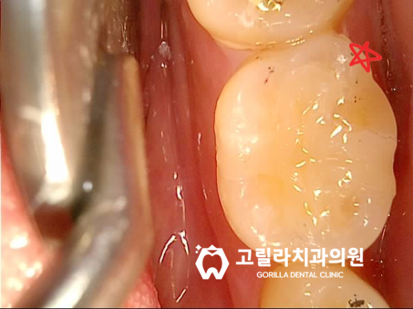 아말감 떼워놓은 것 괜찮은가요? 이미지 10