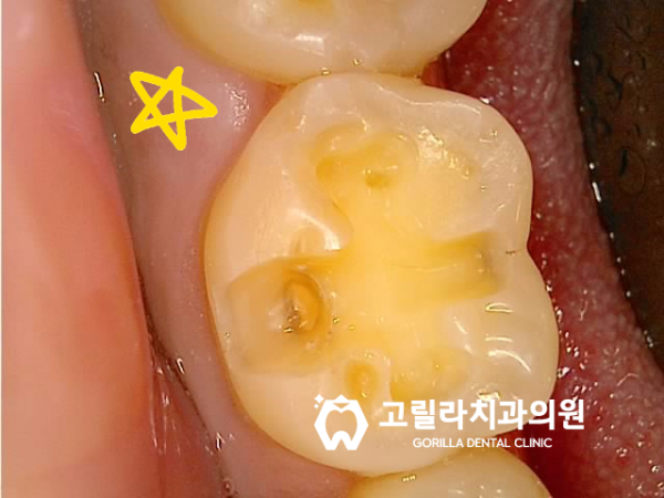 아말감 떼워놓은 것 괜찮은가요? 이미지 7