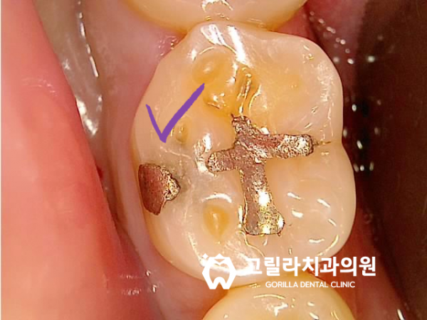 아말감 떼워놓은 것 괜찮은가요? 이미지 6