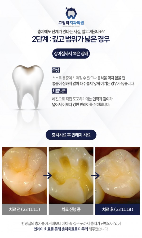 삼가동충치치료의 단계를 고릴라치과에서 확인해보세요! 이미지 4