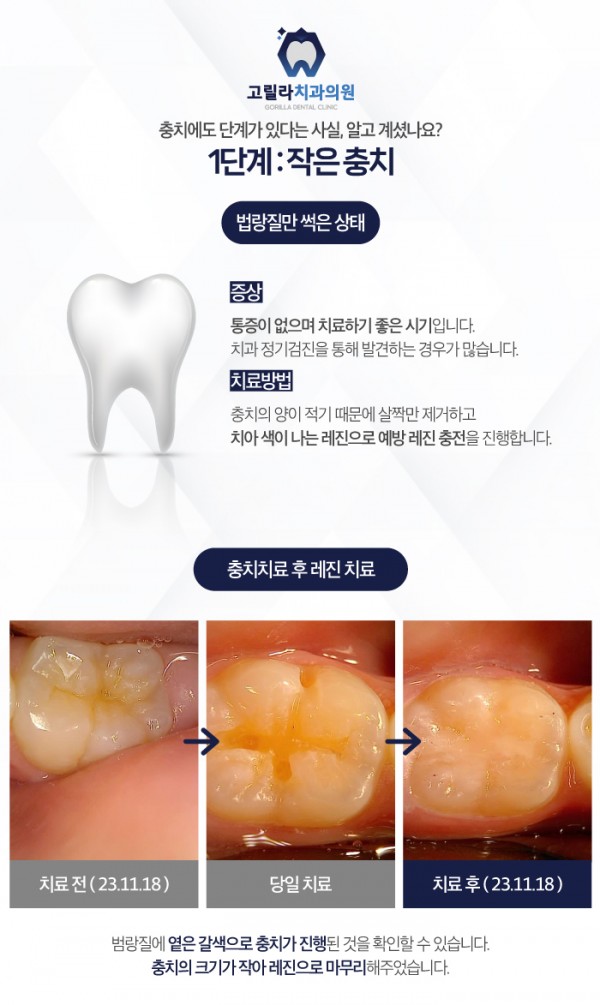 삼가동충치치료의 단계를 고릴라치과에서 확인해보세요! 이미지 2