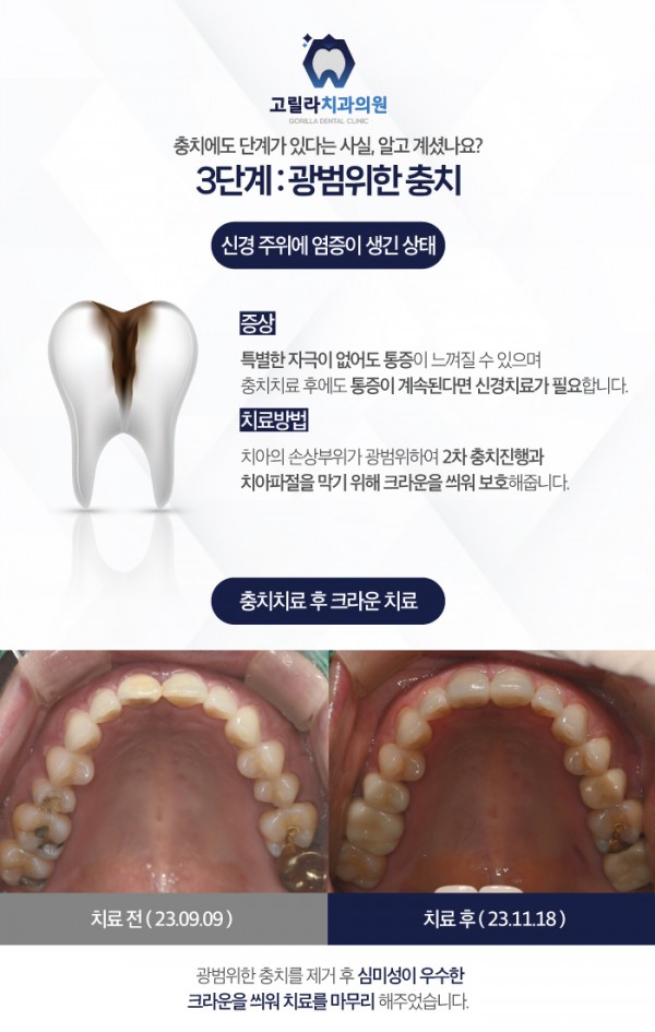 삼가동충치치료의 단계를 고릴라치과에서 확인해보세요! 이미지 6