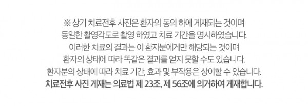 삼가동충치치료의 단계를 고릴라치과에서 확인해보세요! 이미지 3