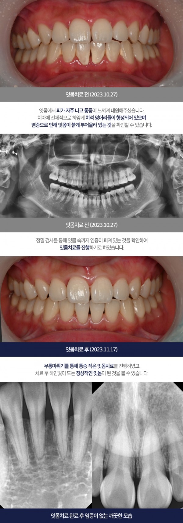 역북동잇몸치료를 통증 적게 진행하는 고릴라치과! 이미지 5