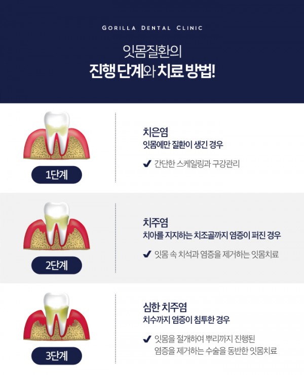 역북동잇몸치료를 통증 적게 진행하는 고릴라치과! 이미지 3