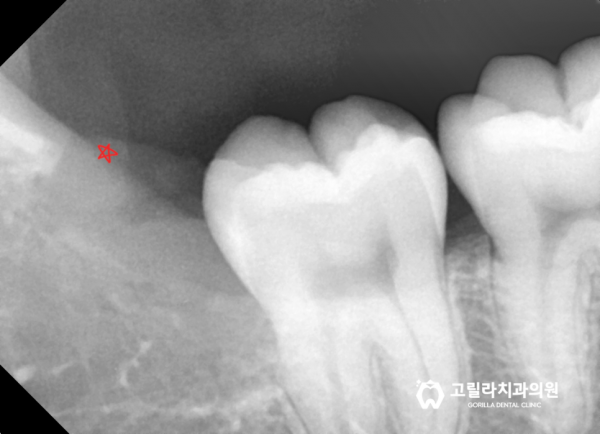 사랑니 뺄 수 있을까요? 대학병원 가야할까요? 이미지 8
