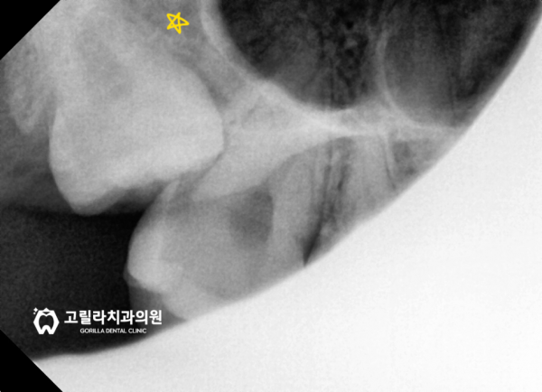 사랑니 뺄 수 있을까요? 대학병원 가야할까요? 이미지 3