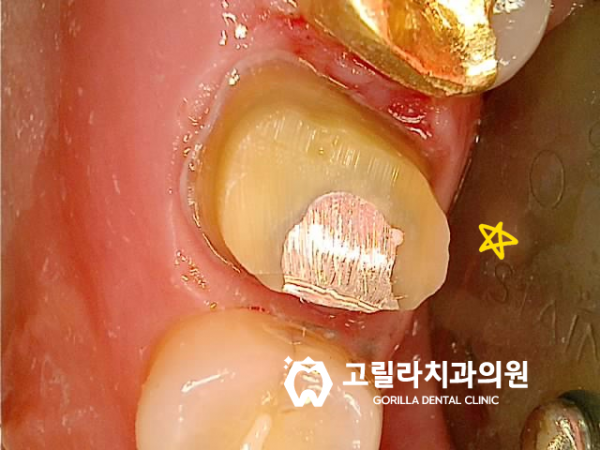 치과치료받은지 오래됐어요, 까매졌어요 이미지 4