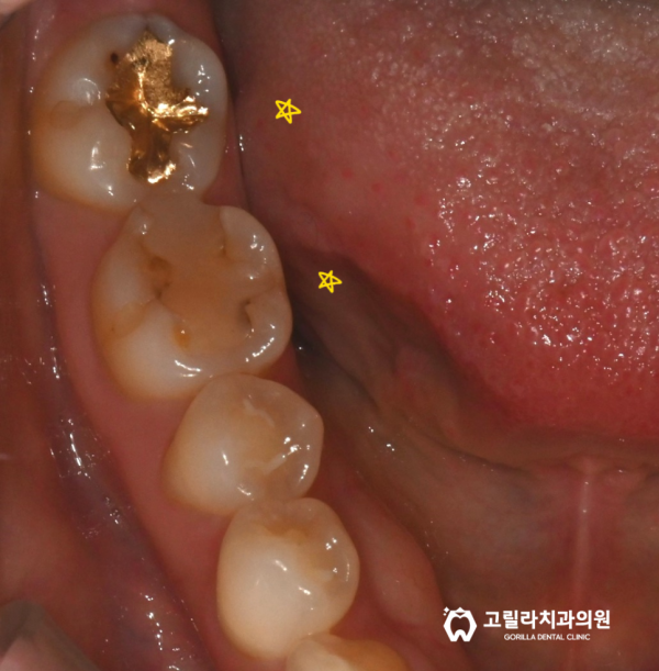 치과치료받은지 오래됐어요, 까매졌어요 이미지 6