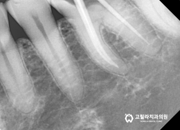 금이간 치아 치료, 씹을 때 시큰거려요 이미지 7