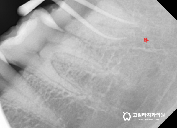 금이간 치아 치료, 씹을 때 시큰거려요 이미지 11