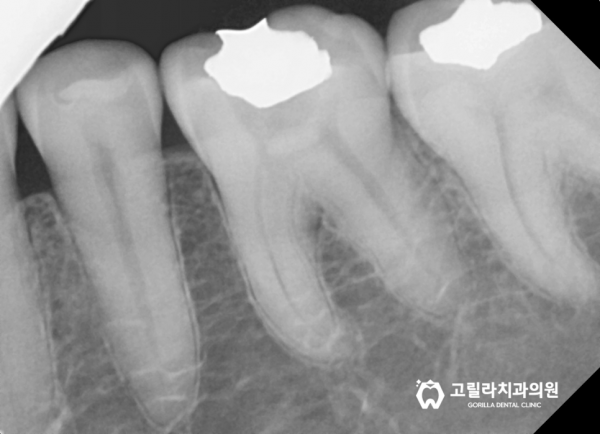 금이간 치아 치료, 씹을 때 시큰거려요 이미지 6