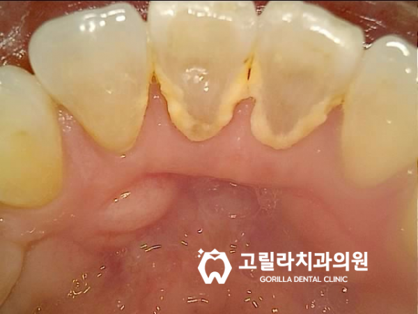 고릴라치과의 특별한 스케일링 이미지 3