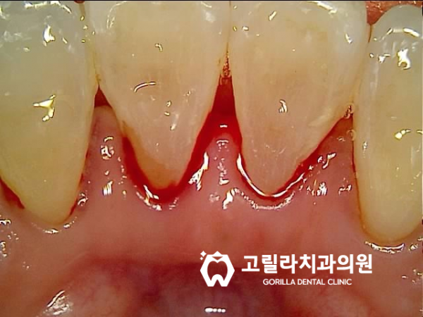 고릴라치과의 특별한 스케일링 이미지 4