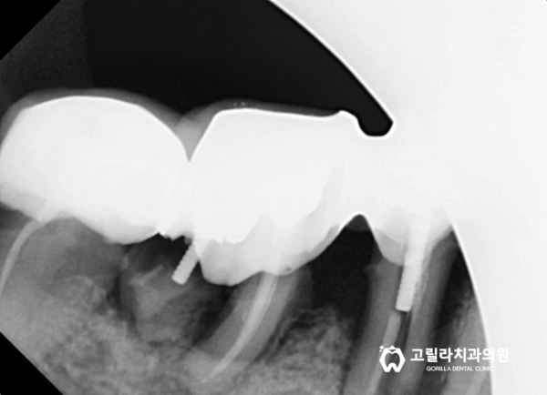 신경과의 거리가 매우 짧아 어려운 임플란트 수술 케이스 이미지 7