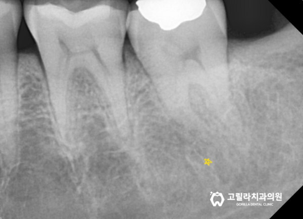 치주염으로 인한 발치 임플란트 수술 이미지 12