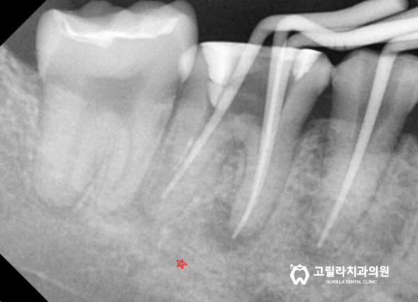 뿌리끝에 염증이 잡힌 재신경치료 이미지 10