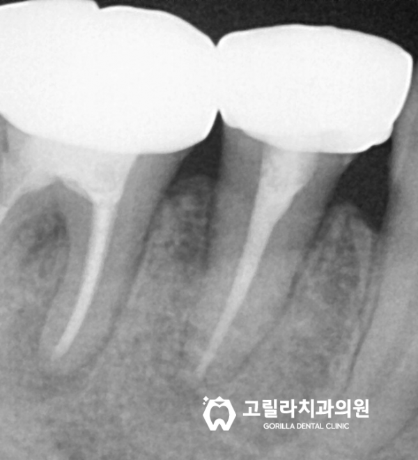 뿌리끝에 염증이 잡힌 재신경치료 이미지 11