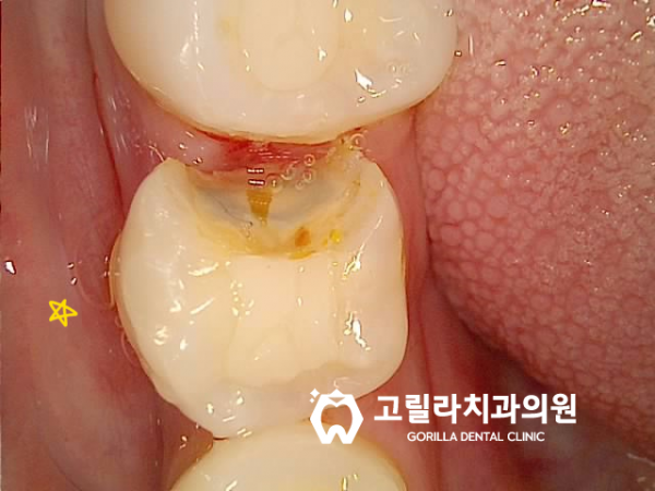 기존 인레이 보철물 깨졌어요 이미지 6