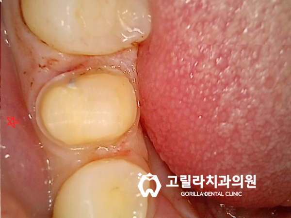 기존 인레이 보철물 깨졌어요 이미지 7