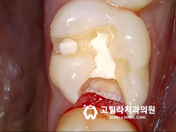 충치로 인한 치아파절 치료방법 이미지 12