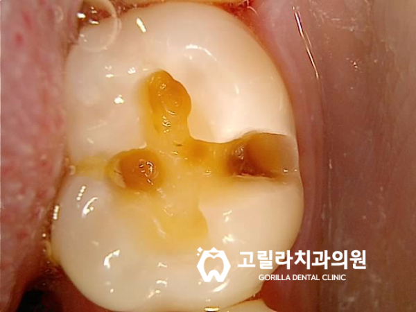 충치로 인한 치아파절 치료방법 이미지 13