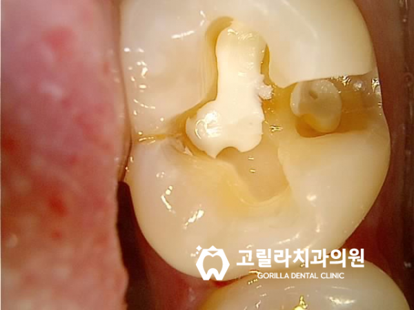 충치로 인한 치아파절 치료방법 이미지 14