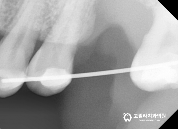 임플란트 혹은 브릿지 치료 선택기준 이미지 12