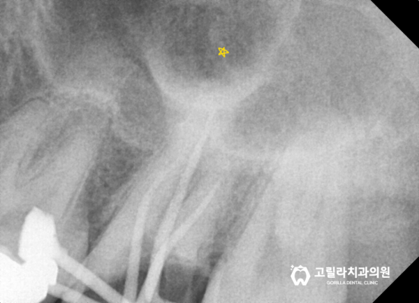 심한 충치, 신경치료를 통한 자연치아 살리기 + 턱관절 보톡스 이미지 8