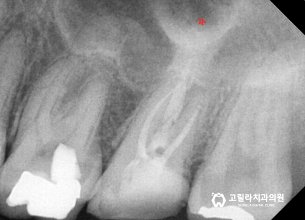 심한 충치, 신경치료를 통한 자연치아 살리기 + 턱관절 보톡스 이미지 9