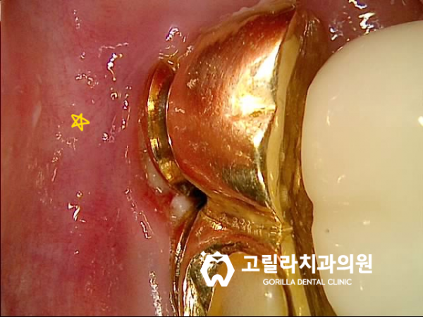타치과 임플란트 보철물 재제작 이미지 5