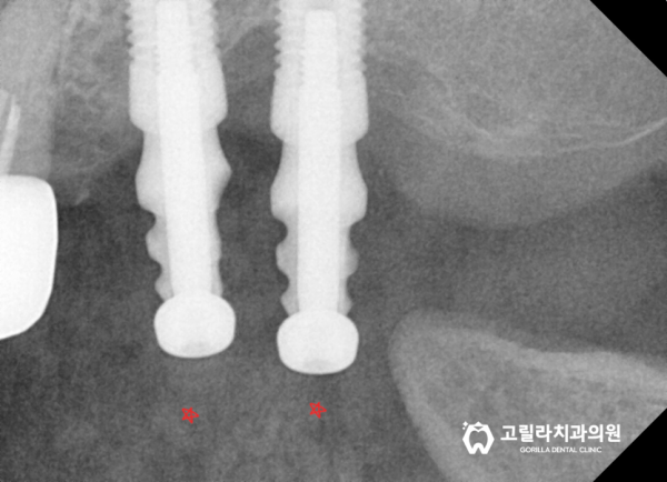 타치과 임플란트 보철물 재제작 이미지 7