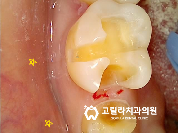충치치료(인레이,크라운,임플란트) 이미지 12