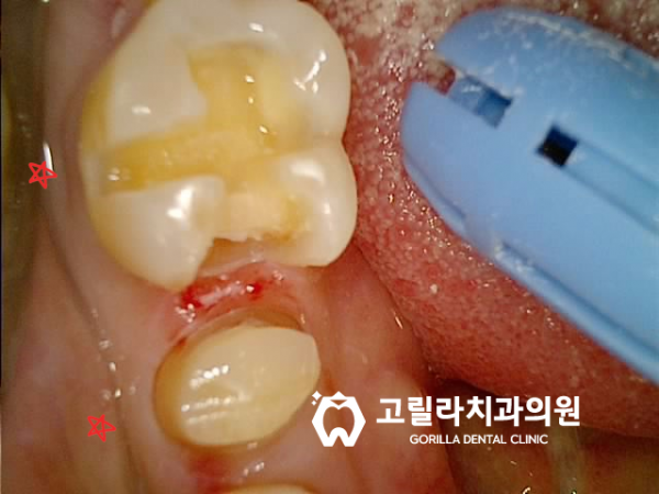 충치치료(인레이,크라운,임플란트) 이미지 13