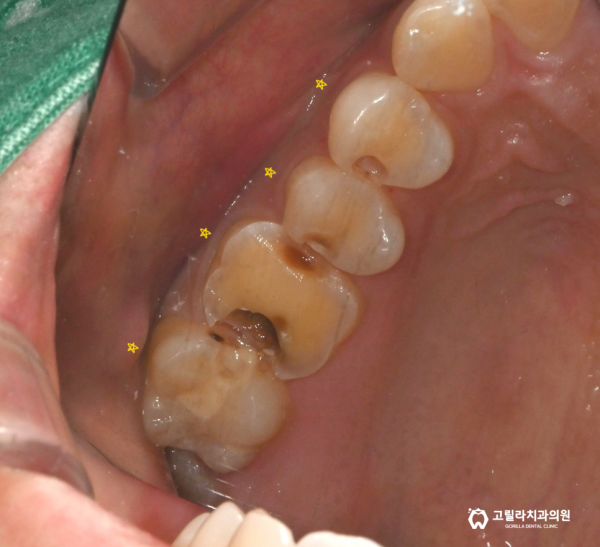 자연치아 보존치료, 인레이 크라운 치료 (치실 사용 중요성) 이미지 9